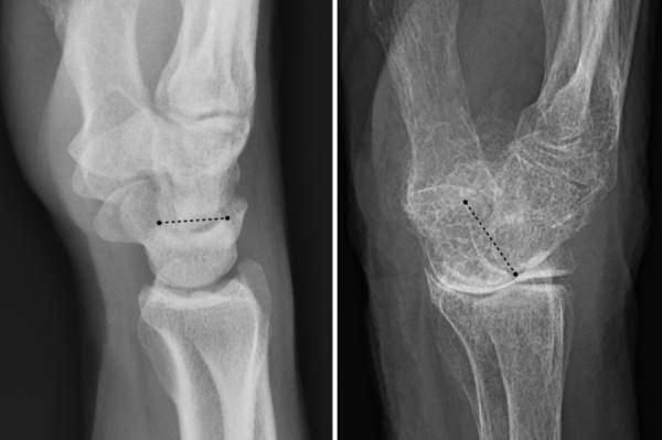 一个正常的手腕（左图）和一个（右图）由于骨质疏松导致腕关节倾斜。