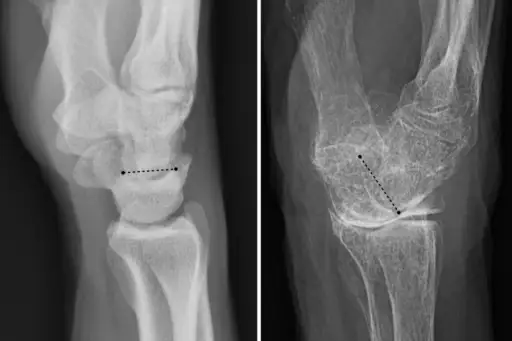 一个正常的手腕(左图)和一个(右图)由于骨质疏松症导致的手腕关节倾斜。