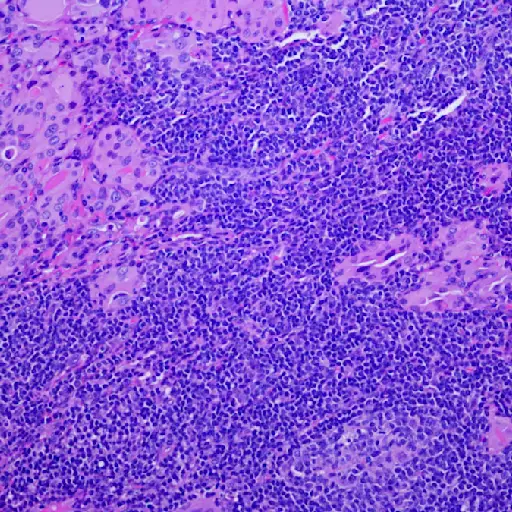 Micrograph of Hashimoto thyroiditis