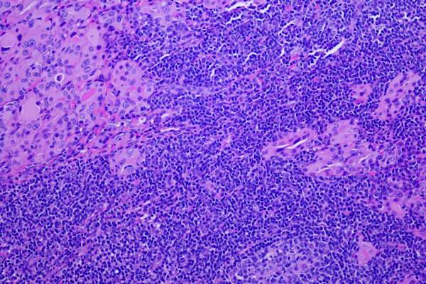 桥本甲状腺炎的显微