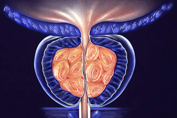 良性前列腺增生,第3阶段