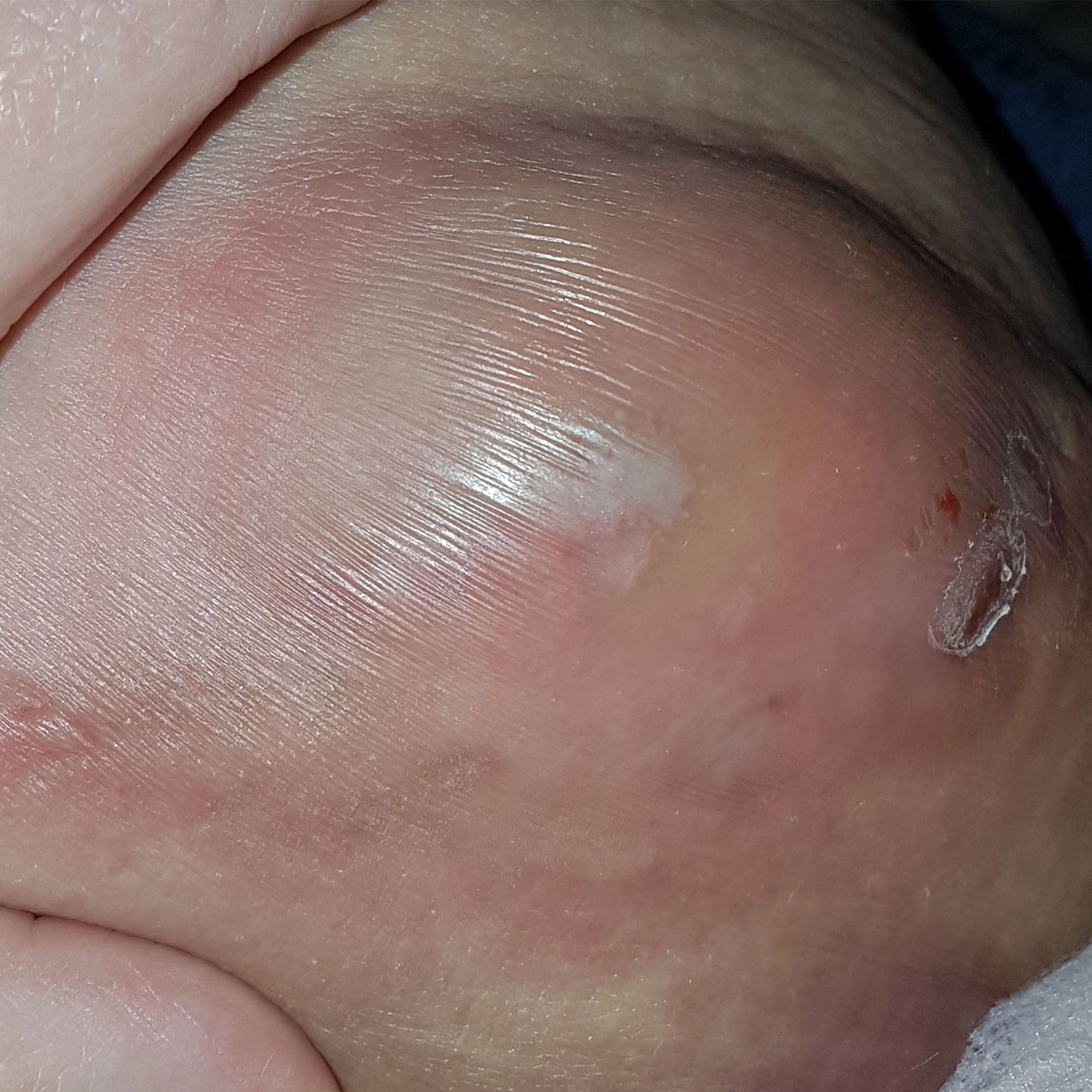 Is this hiradenitis? Having boils come and go on my inner thighs