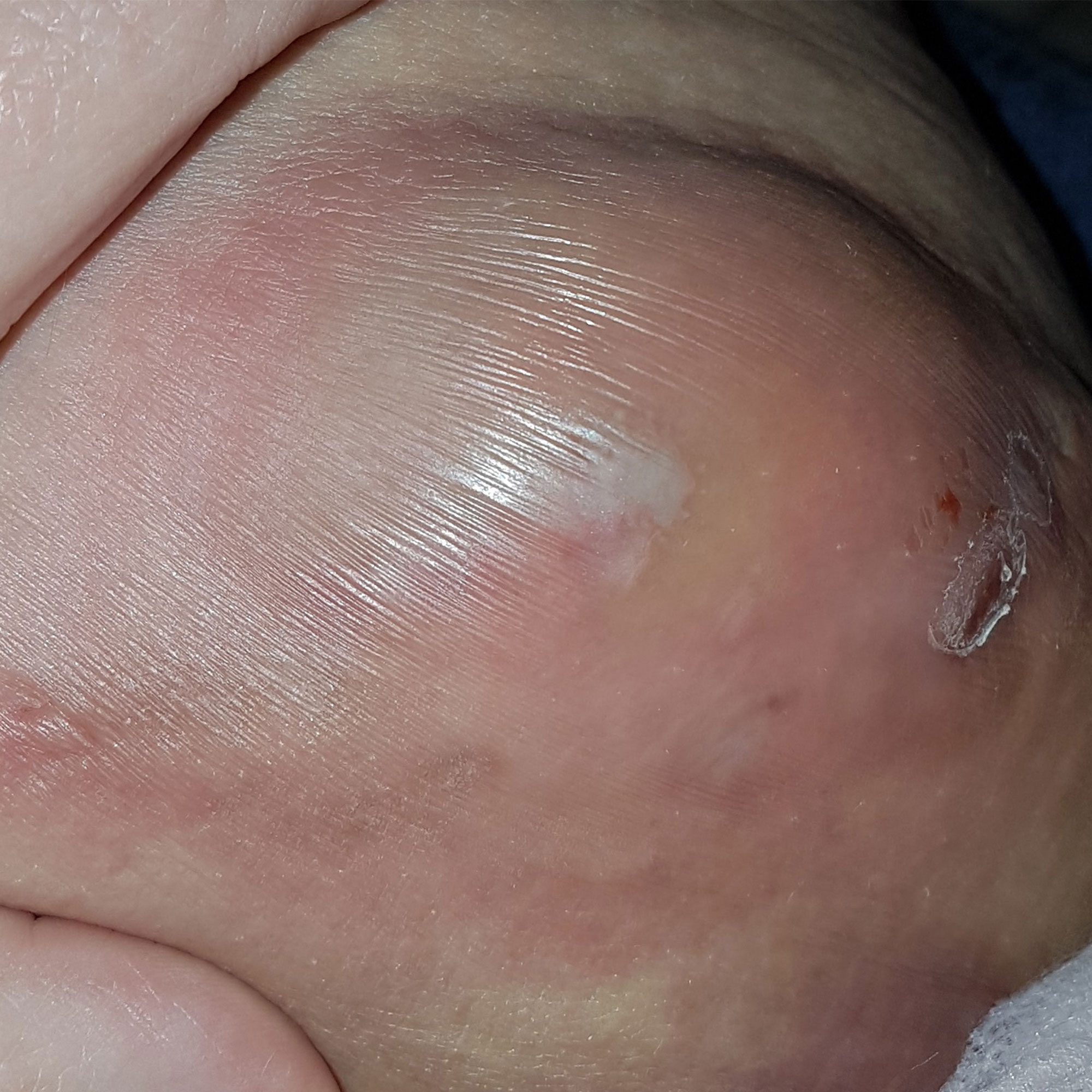 What is this - painful lump inner thigh??