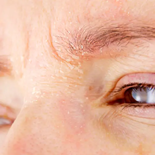 psoriasis treatments for face vörös foltok kezelése bórsavval