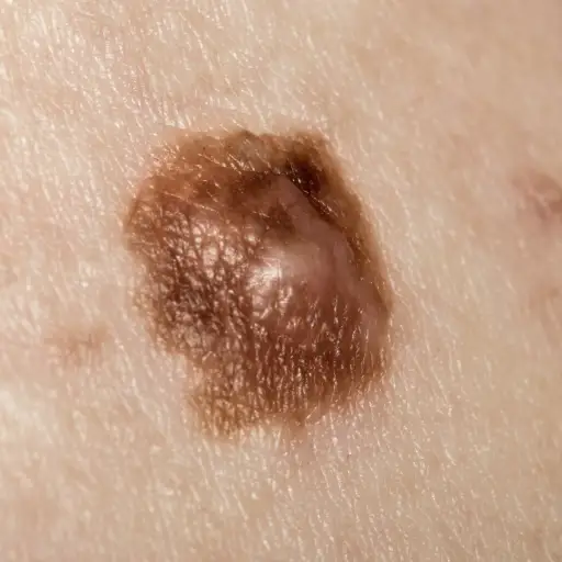 6 Kinds Of Skin Cancer And Their Symptoms