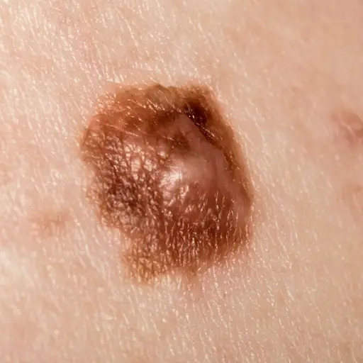 6 Kinds Of Skin Cancer And Their Symptoms