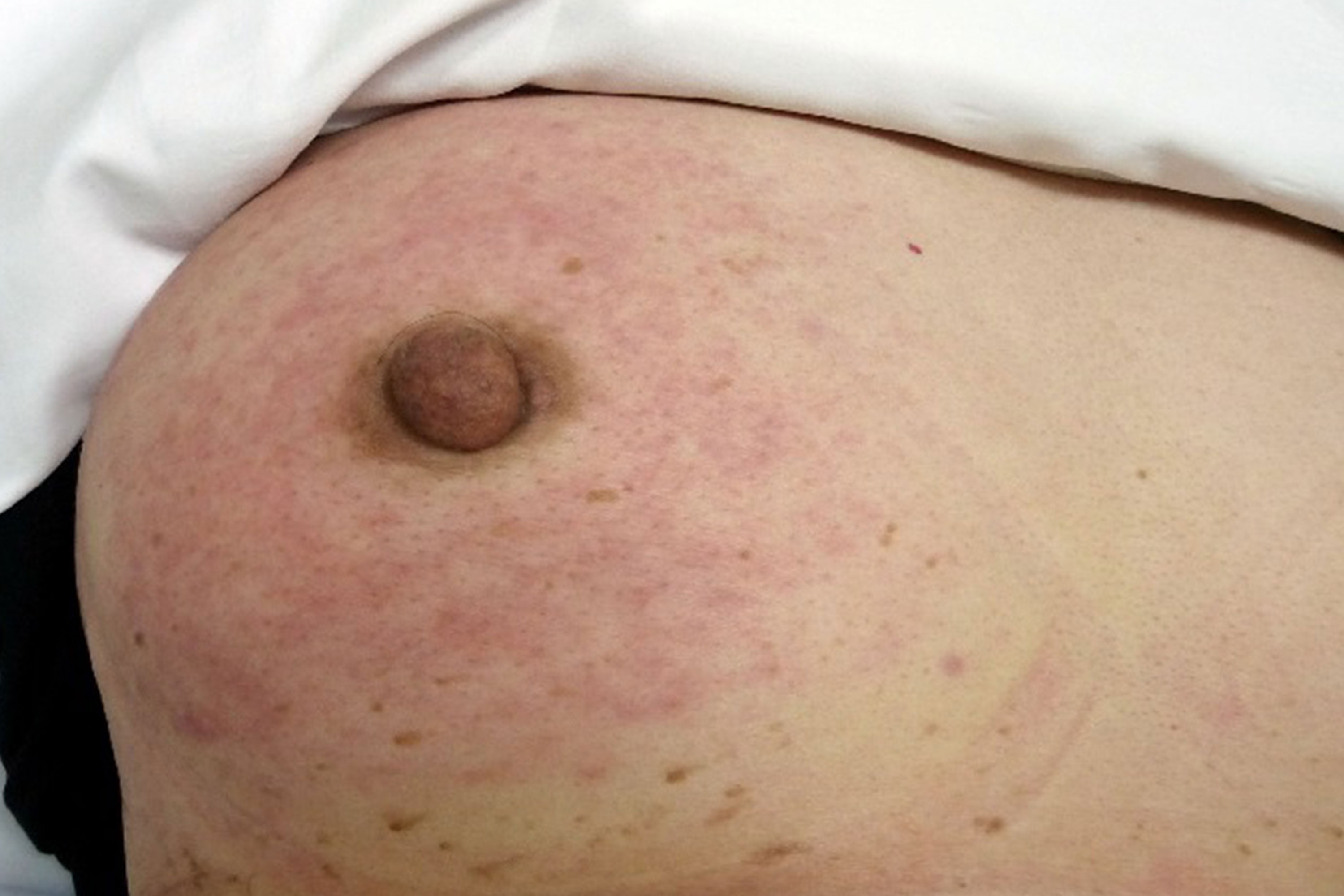Red lump on breast