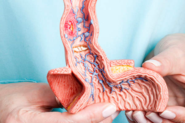 医生拿着食道和胃的模型。