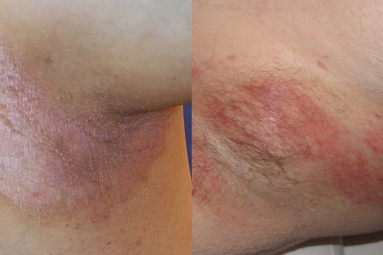 Inverse Psoriasis vs. Intertrigo What's the Difference