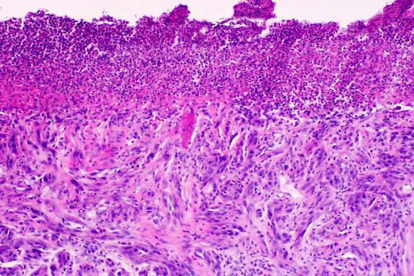 结缔组织增生黑色素瘤