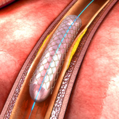 血管成形术和支架植入