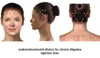 女性头部的肉毒杆菌注射部位突出显示。