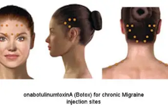 女性头部的肉毒杆菌注射部位突出显示。