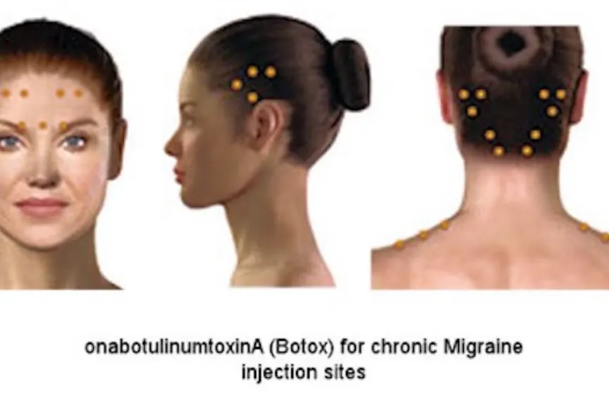 女性头与肉毒杆菌的注射部位突出显示