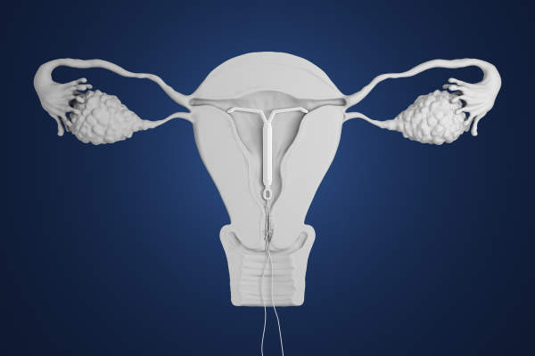 iud options birth control hormonal stage every backup condom plan