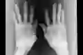 An x-ray of hands showing rheumatoid arthritis in the wrists