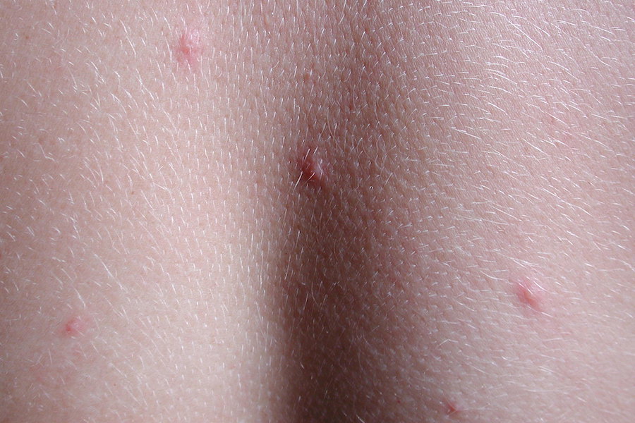 microscopic bug bites