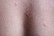 Red Spot On Breast Looks Like Bug Bite Renew Physical Therapy