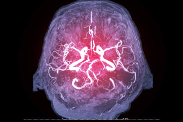 显示脑部血管的核磁共振成像