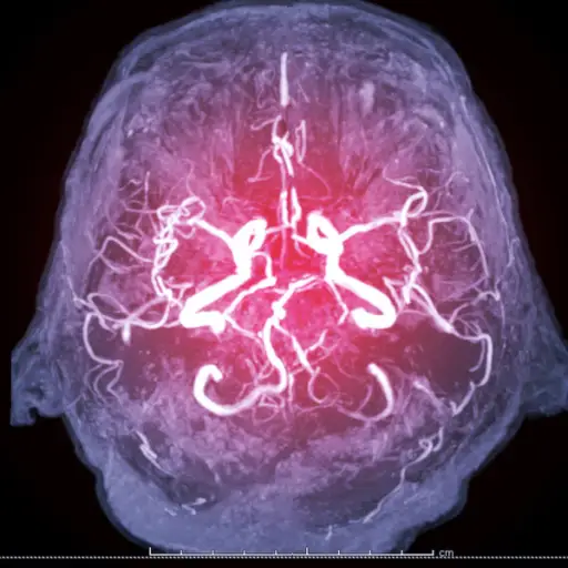 MRI显示大脑中的血管