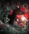 镰状细胞性贫血