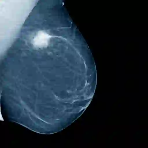 有肿瘤的乳房的x光照片