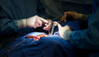 心脏外科手术主动脉瓣膜置换异种移植