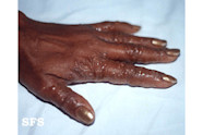 Eachma Dyshidrotic Ar Na Cosa Dyshidrotic Eczema Dyshidrosis 