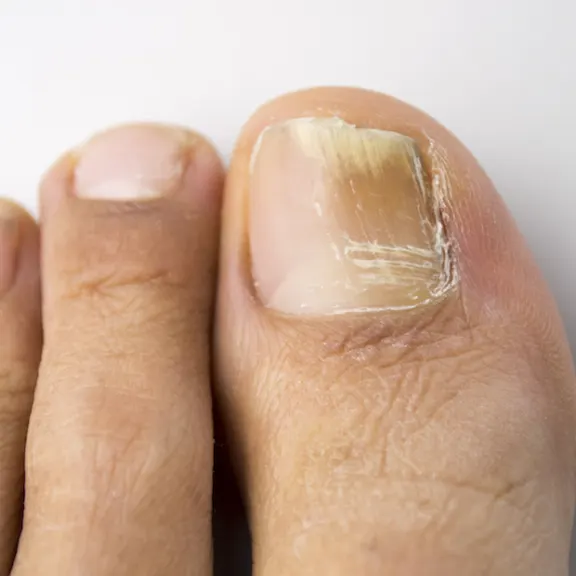 Toenail Fungus Treatment in North Texas- Graff Foot, Ankle and Wound Care