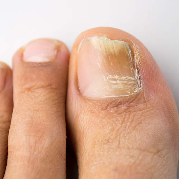How To Treat Toenail Fungus