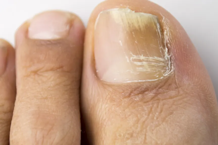 How long does it take for toe fungus to heal How To Treat Toenail Fungus