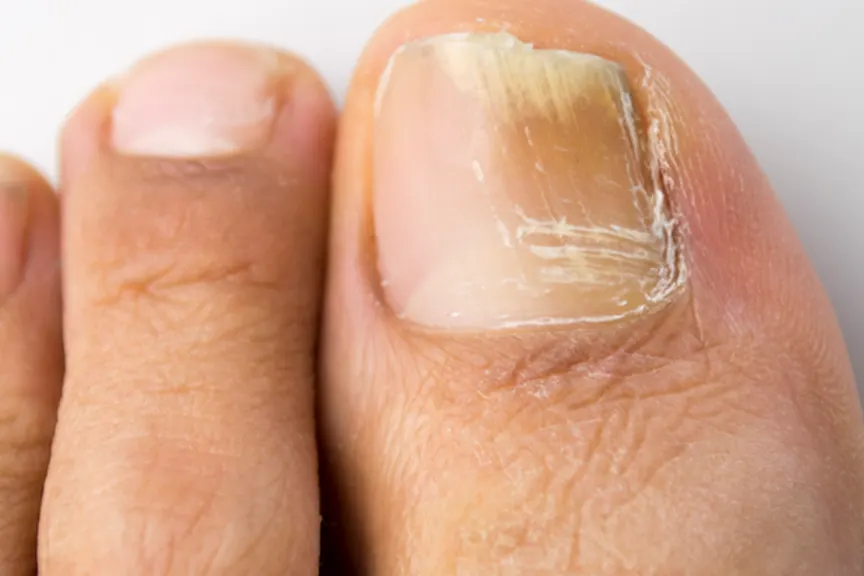 Toenail Fungus Treatment in North Texas- Graff Foot, Ankle and Wound Care