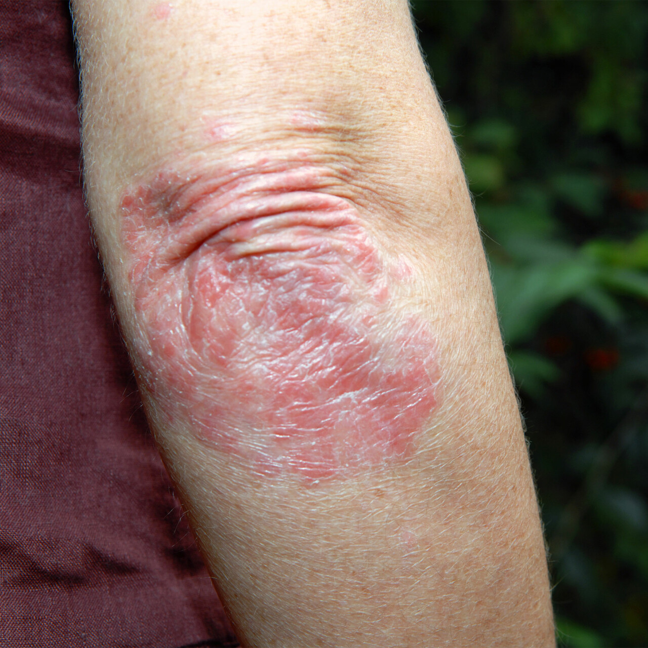 在肘部牛皮癣的特写镜头