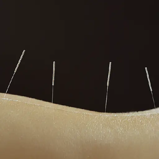 accupuncture