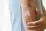 A view of psoriasis on a man’s elbow