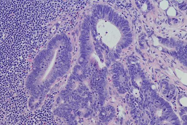 metastatic colon cancer