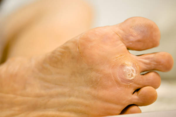 脚底的足底疣。