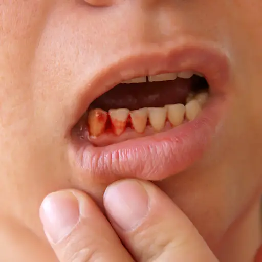 血腥的牙龈