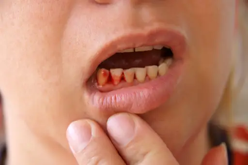 血腥的牙龈