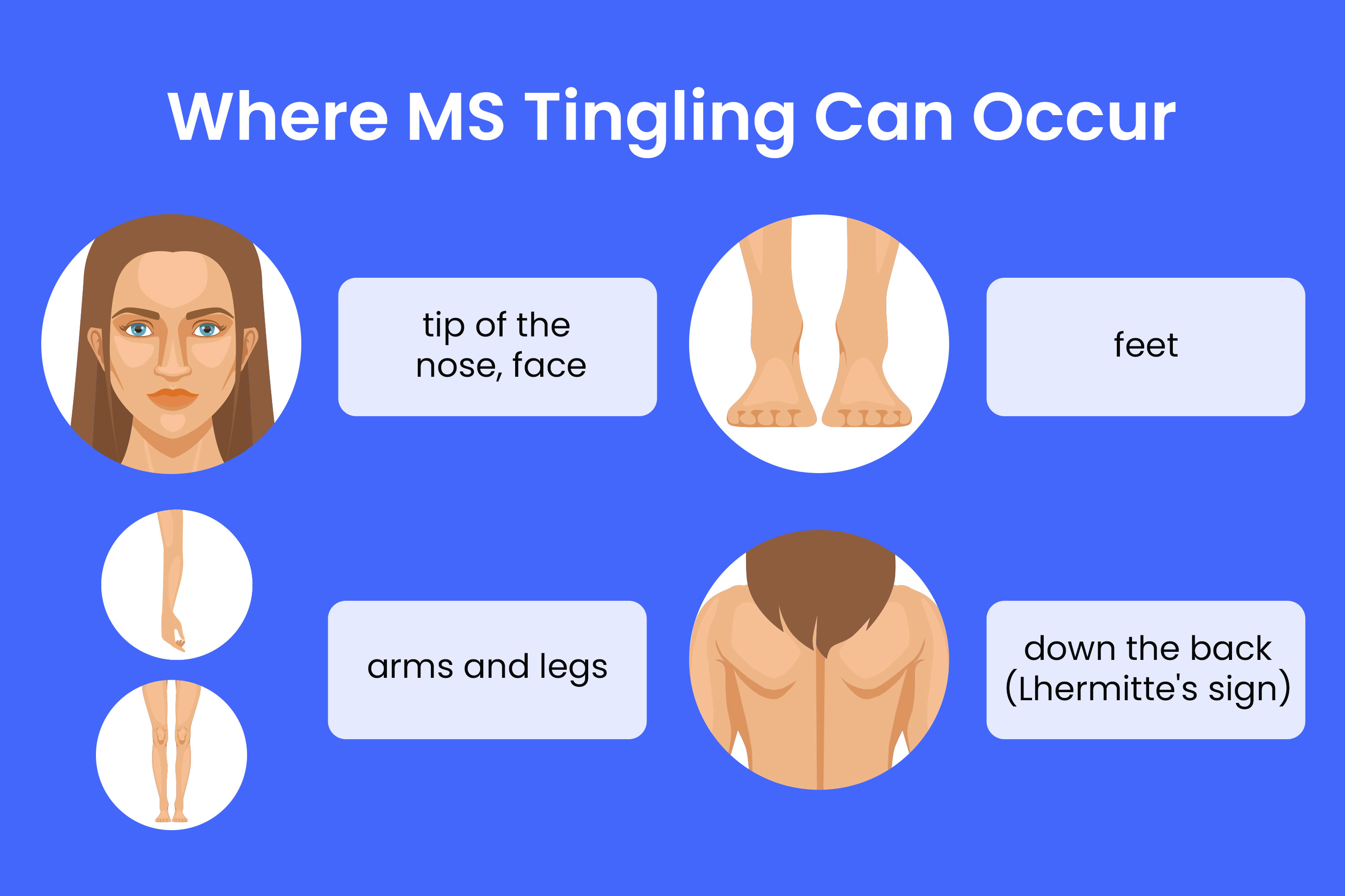 MS Tingling: Causes, Feels Like, Treatment, and More