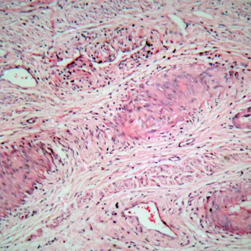 来自人宫颈的组织细胞与宫颈癌细胞