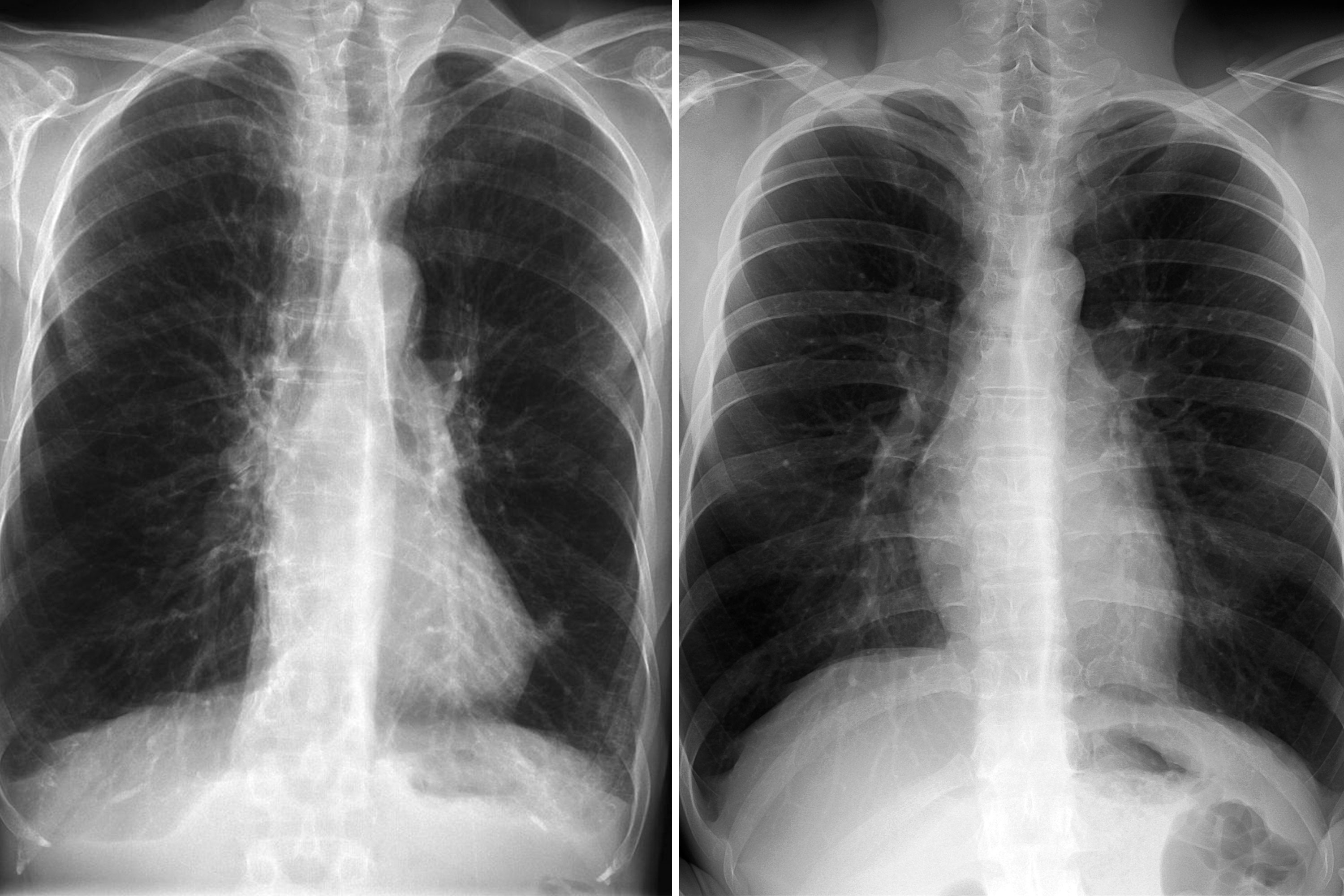 COPD Lungs vs. Normal Lungs on Medical Scans