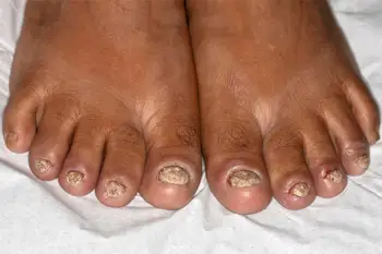 A view of psoriasis on feet