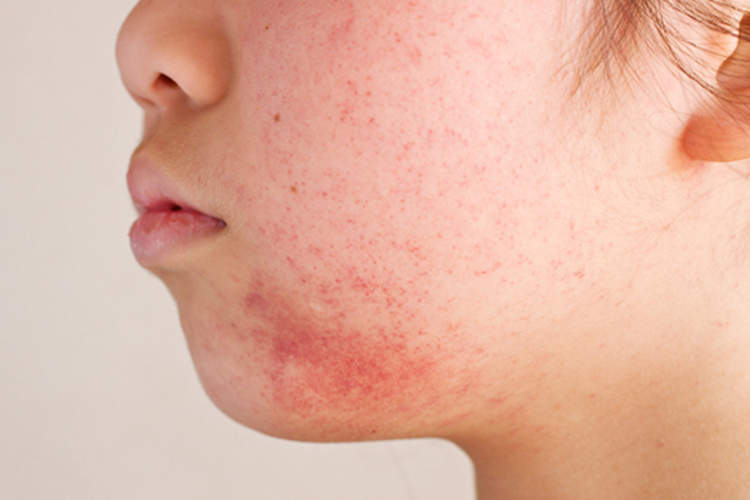 脸上有疹子的女孩。