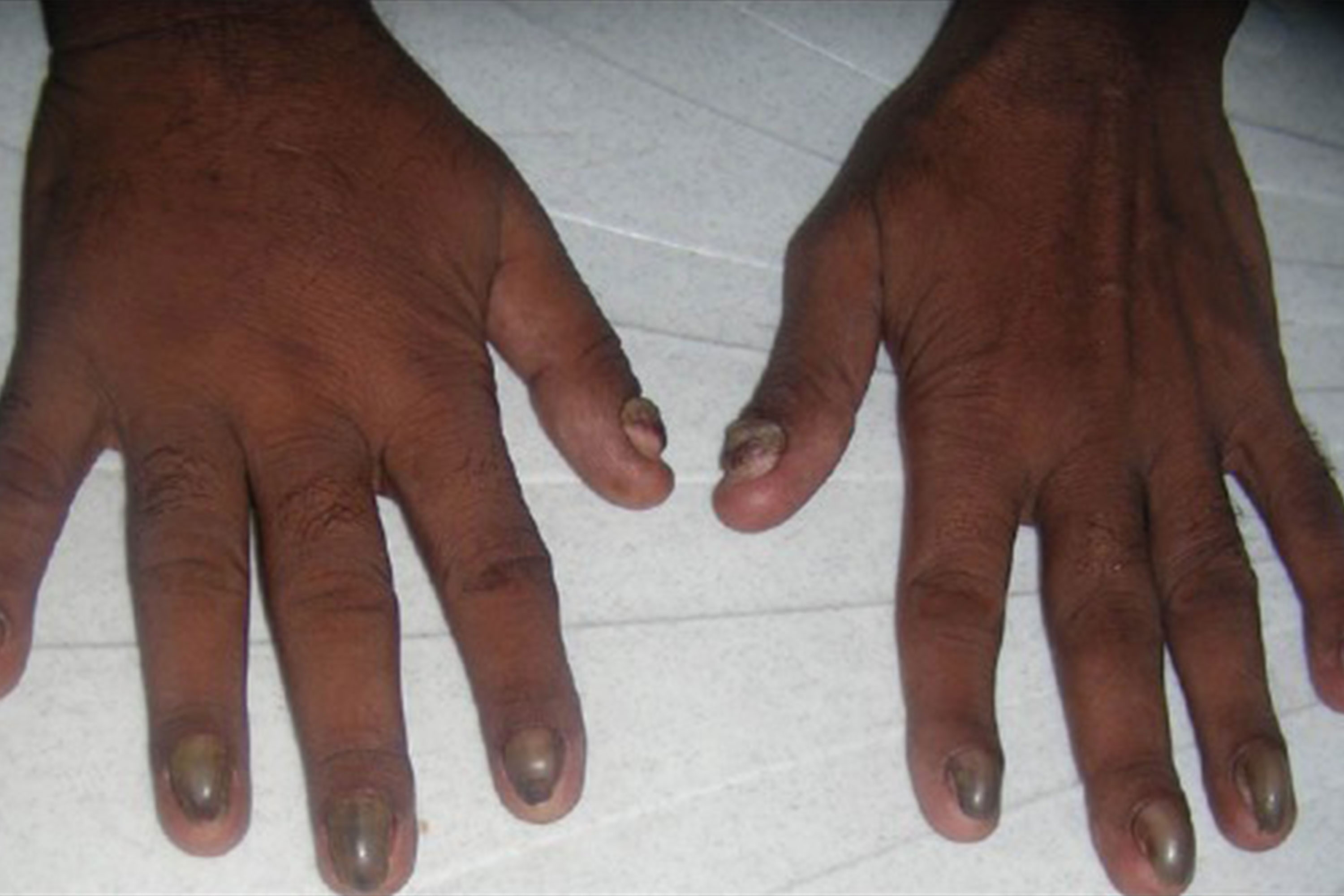 Aarogyadham Super Speciality Hospital - Yellow nail syndrome is a rare  disease that affects your fingernails and toenails. People with yellow nail  syndrome may also develop pulmonary and lymphatic system problems. This