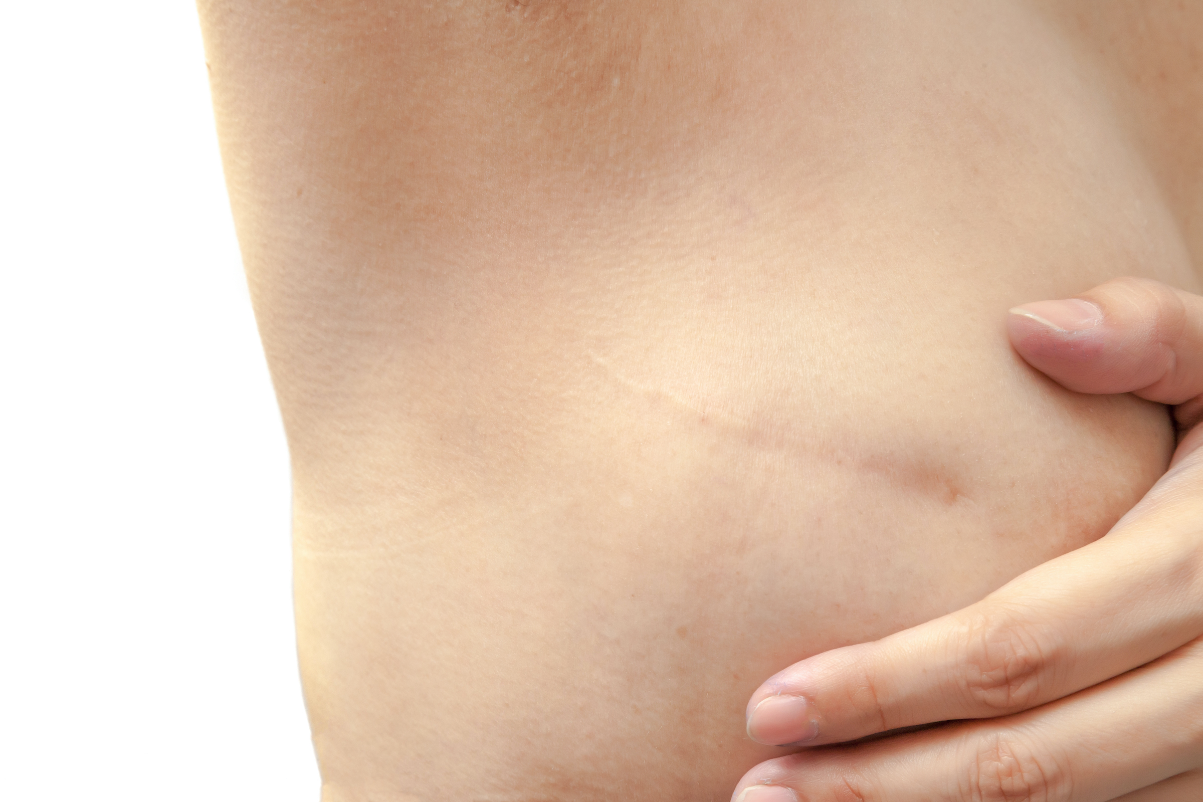 Everything You Need To Know About Getting A Mastectomy 