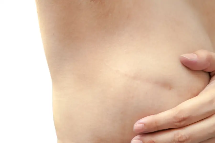 3 Things To Know About Nipple Scabbing After Mastectomy