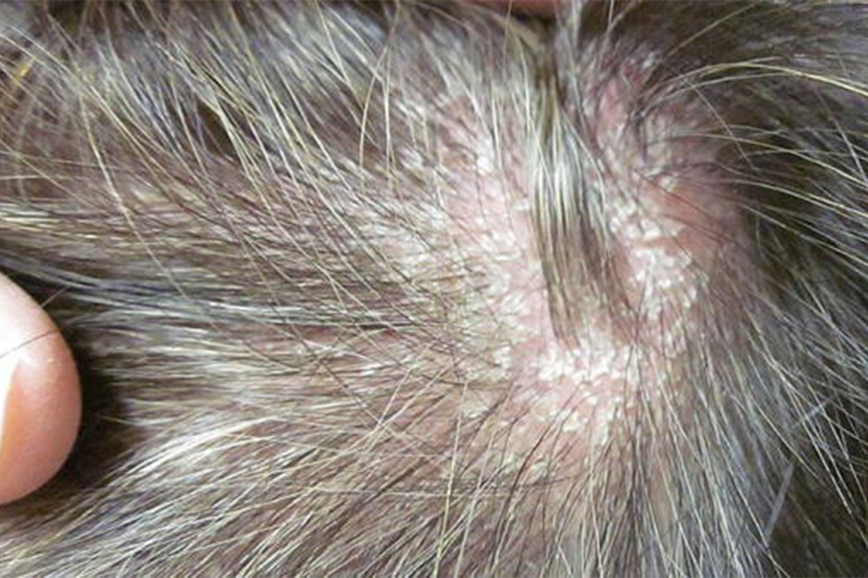 psoriasis scalp treatment natural