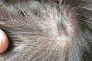 Scalp Psoriasis Symptoms Images Infoupdate