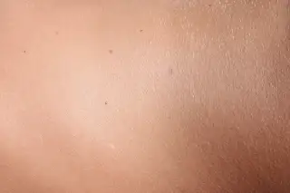 black bumps on skin